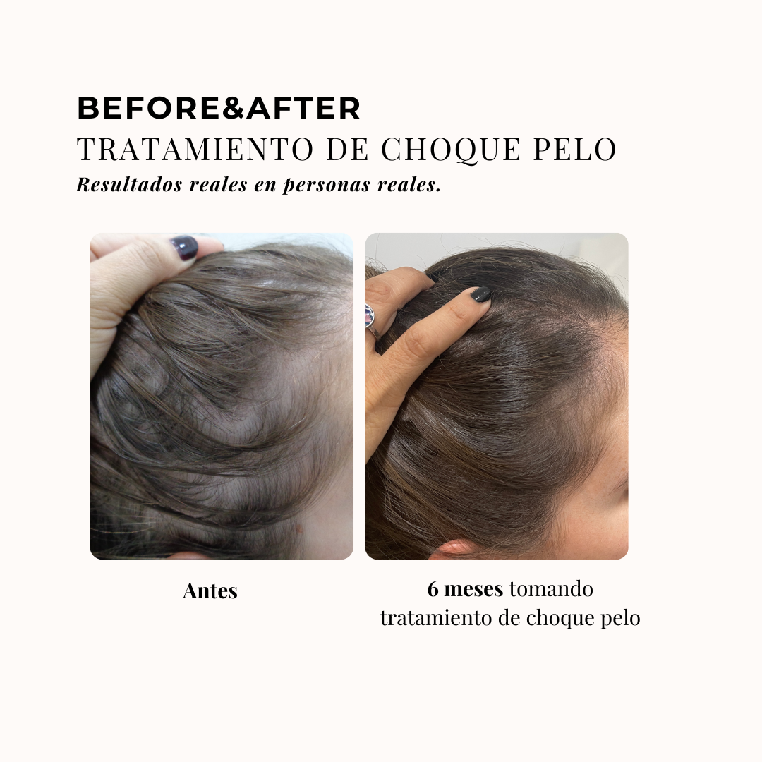 3-MONTH HAIR SHOCK TREATMENT