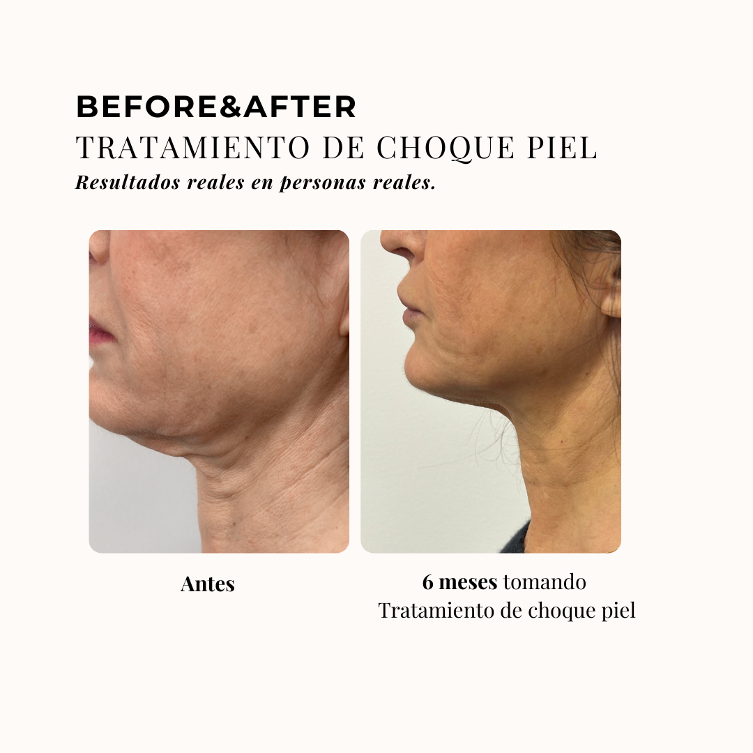 TRATAMIENTO DE CHOQUE PIEL 3 MESES