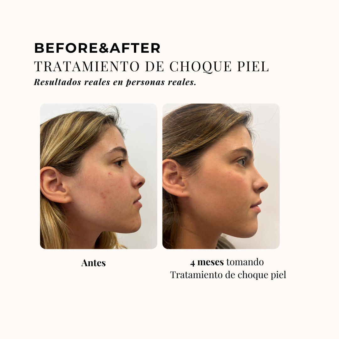 TRATAMIENTO DE CHOQUE PIEL 3 MESES