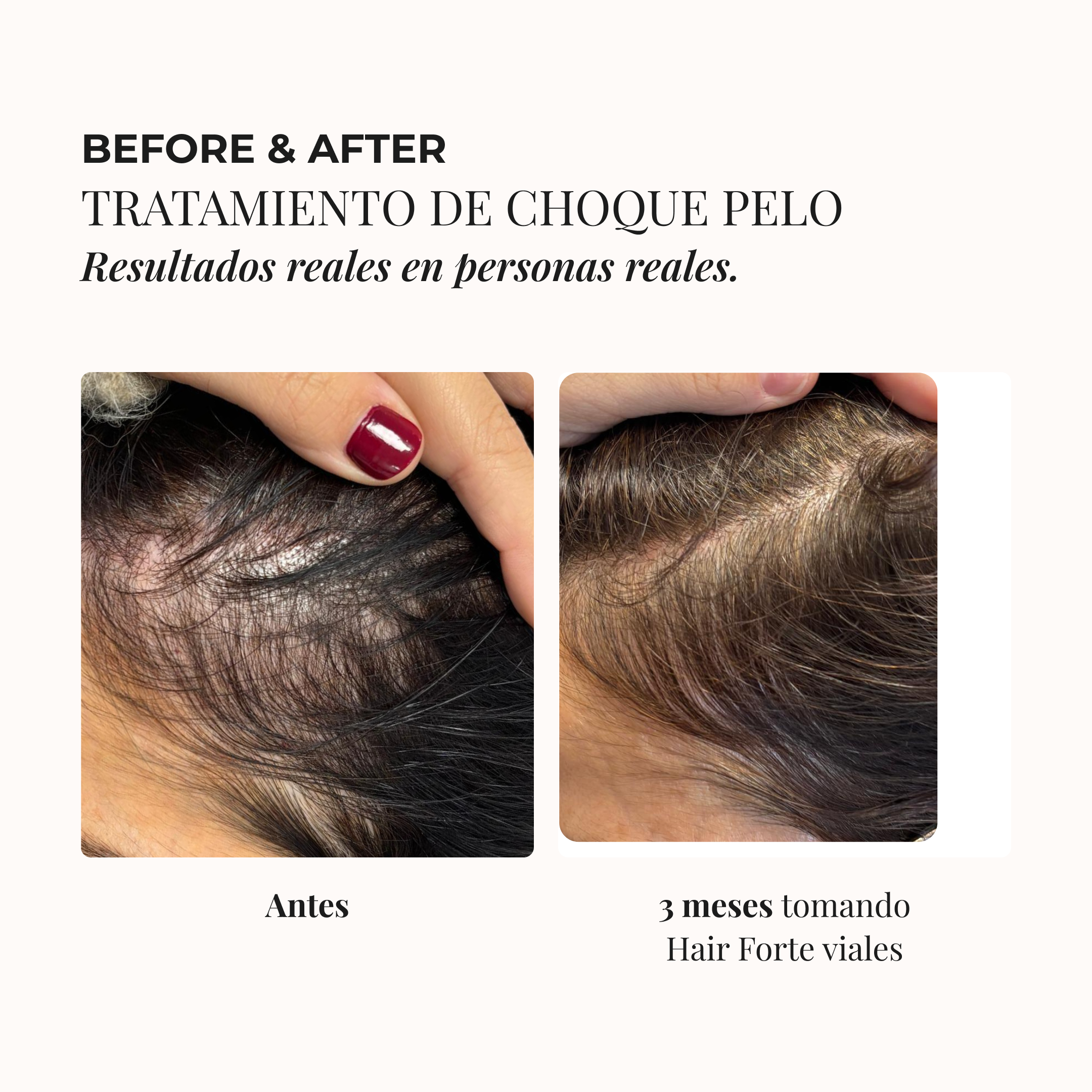 TRATAMIENTO DE CHOQUE CAPILAR 3 MESES