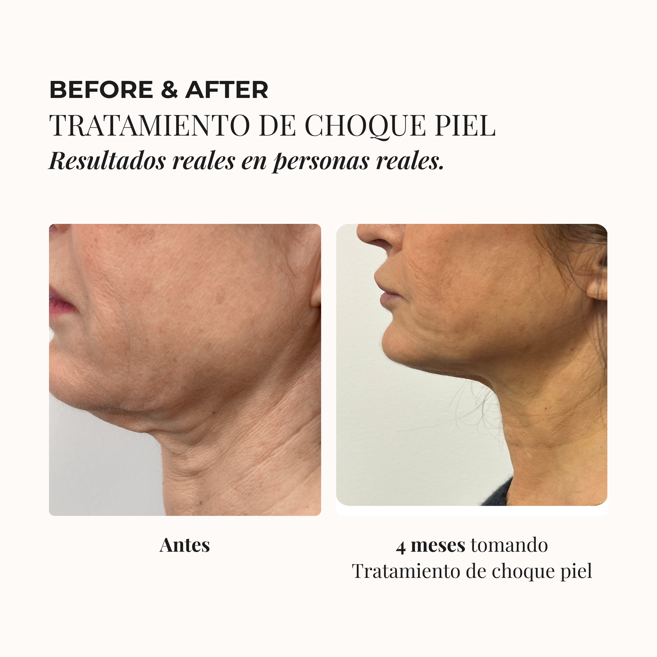 3-MONTH SKIN SHOCK TREATMENT