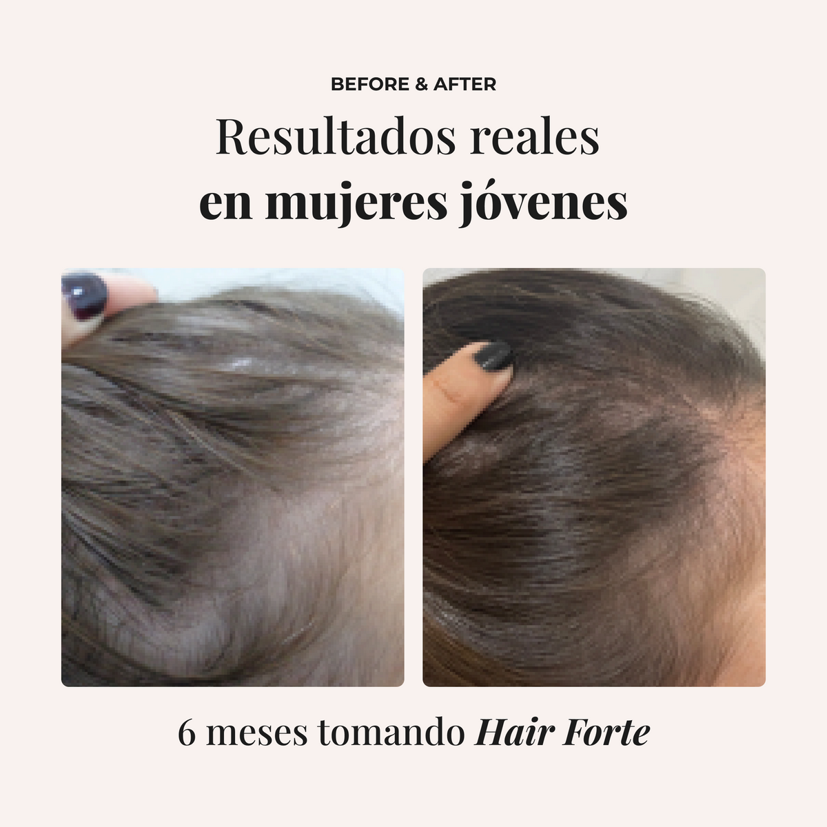 Comparativa antes y después de seis meses en una clienta joven